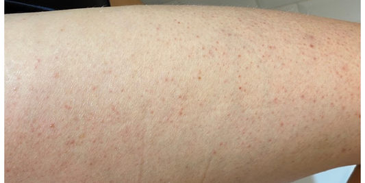 keratosis pilaris, chicken skin, strawberry skin