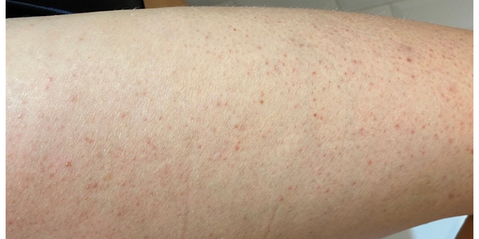 How we help with Keratosis Pilaris